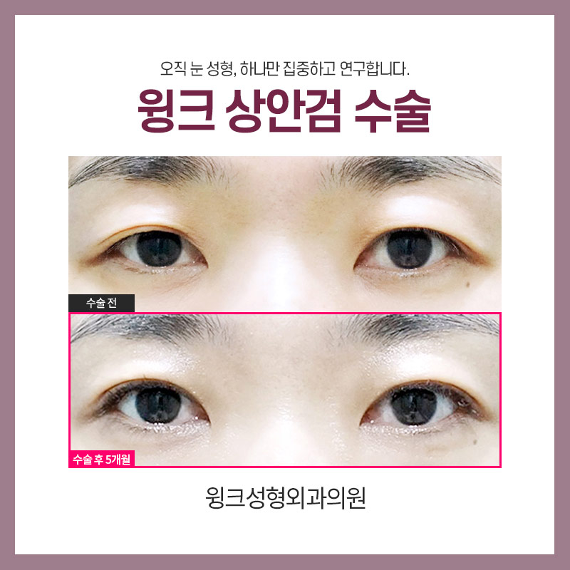 중년눈성형 상안검수술을 알아보자. 관련 이미지 3