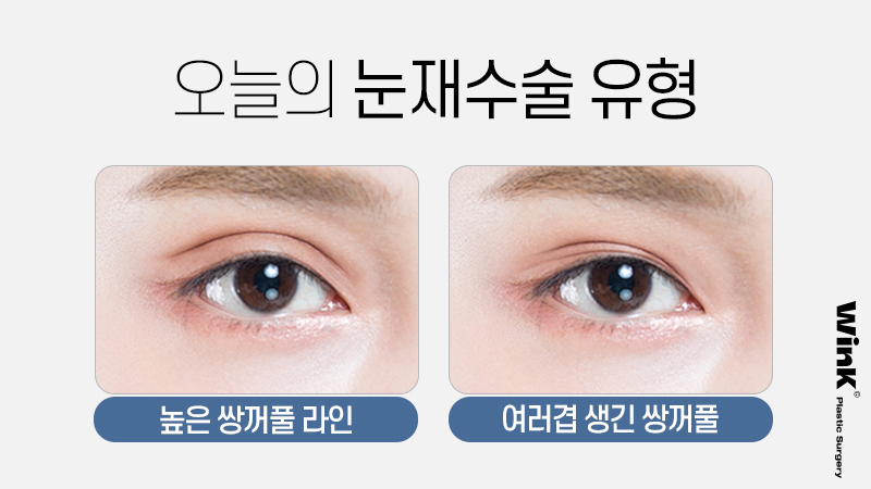 높은 쌍꺼풀 라인, 겹쌍꺼풀과 같은 유형의 눈재수술 방법은? 관련 이미지 2