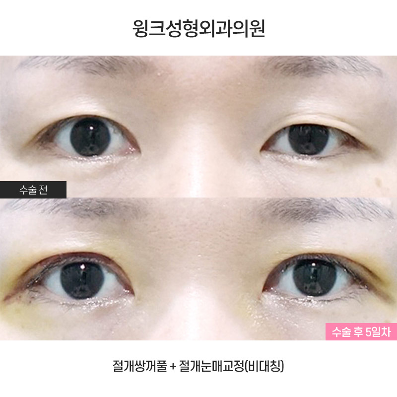 비대칭 안검하수 눈매교정은 어떻게 하는 것일까? 관련 이미지 1