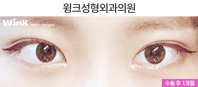 If You’re Looking Into Revision Double Eyelid Surgery, Visit Wink Plastic Surgery for Beauty and Function! image 3
