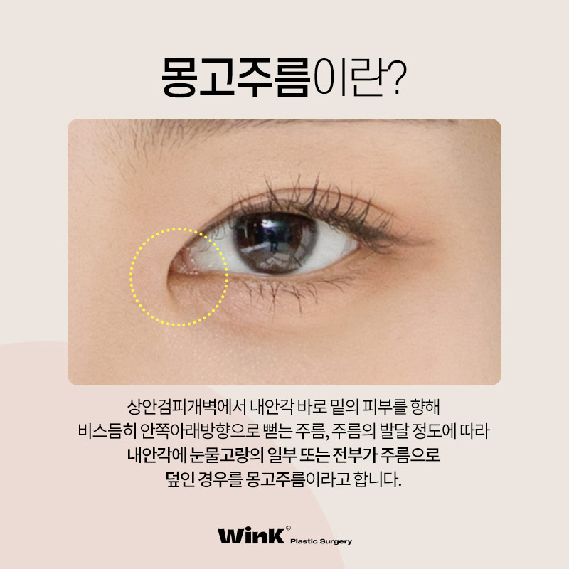 The Impact of Epicanthal Folds on Double Eyelid Surgery! Epicanthoplasty, Epicanthoplasty Cost, Sinsa Epicanthoplasty image 2