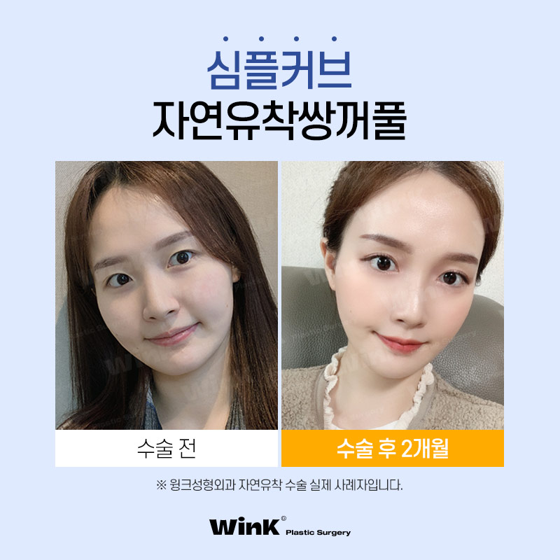 윙크성형외과 심플커브 자연유착 자연유착쌍꺼풀후기 자연스러운쌍수 쌍수자연유착 관련 이미지 6