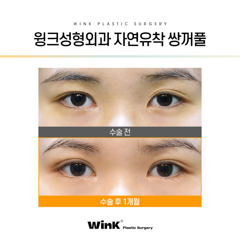 절개쌍꺼풀잘하는곳 눈수술후관리 윙크성형외과에서 눈성형 궁금증 풀어드려요 관련 이미지 3