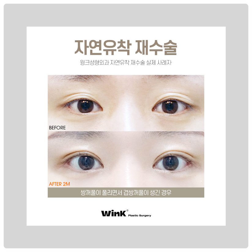 자연유착재수술 신사자연유착비용 신사눈재수술전후 알아본다면 윙크성형외과! 관련 이미지 4
