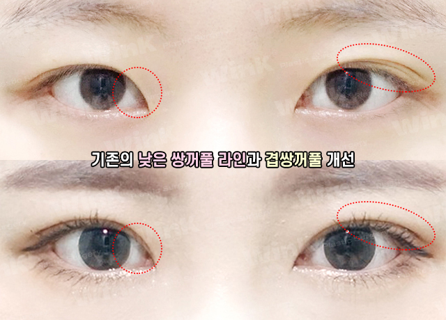 Fast Return to Daily Life and Natural Lines with Wink Natural Adhesion! image 6