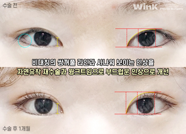 나도 자연유착으로 재수술 할 수 있을까? 관련 이미지 8