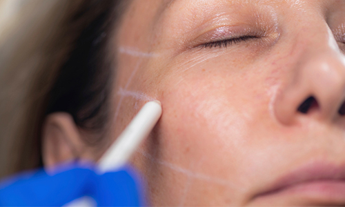 Let’s Take a Look at What to Watch Out for When Planning Double Eyelid Surgery in Middle Age. image 5
