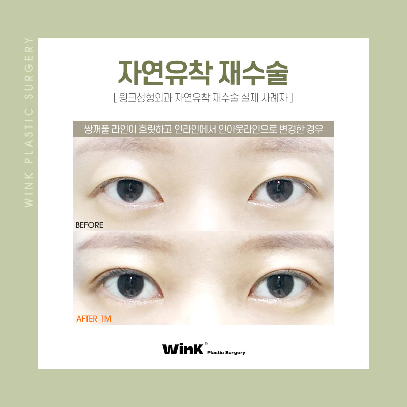 Natural and Clear Fixation for a Natural Adhesion Revision Surgery at Wink Plastic Surgery with No More Failures image 6
