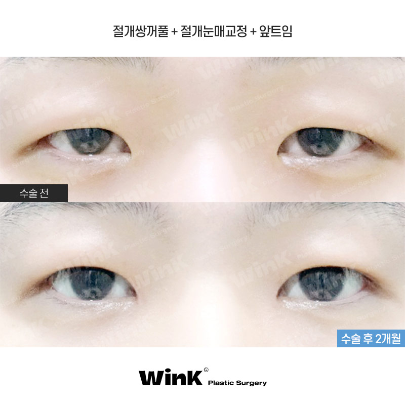 Does He Look Sleepy Because of Ptosis? At Wink Plastic Surgery, Get a Natural and Refreshed Eye Shape! image 1