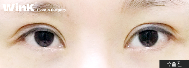 Thick Double Eyelids, “Sausage Eyes.” Let’s Improve Them Naturally with Wink’s Double-Incision Double Eyelid Revision Surgery! image 8