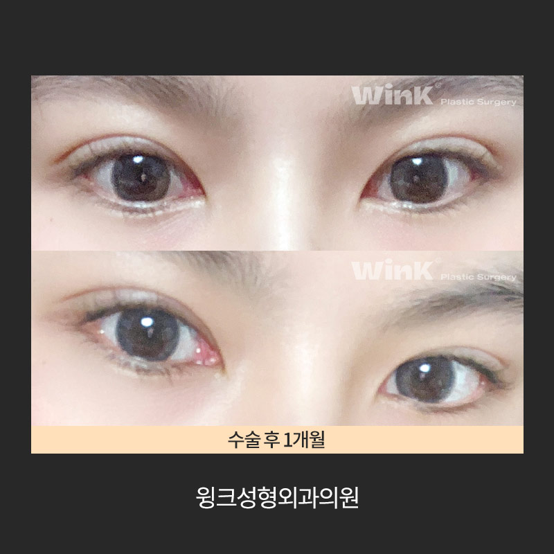 How Do You Release Deep Double Eyelid Fixation? image 6