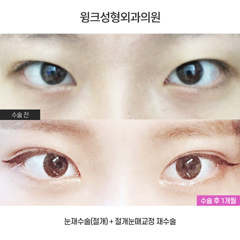 If You’re Looking Into Revision Double Eyelid Surgery, Visit Wink Plastic Surgery for Beauty and Function! image 1