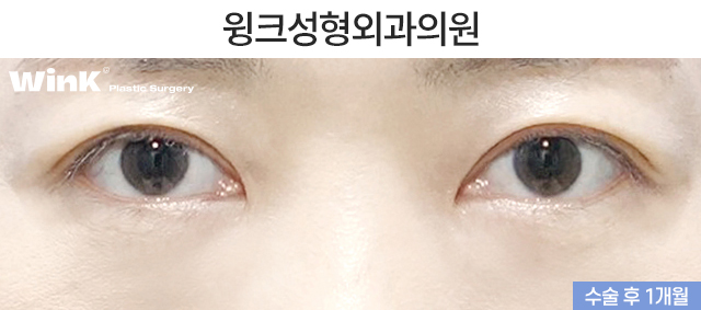 Lower Eyelid Fat Repositioning: Who Is It Effective For? image 6