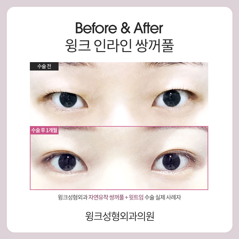 A Natural Line That Looks Just Like Your Original Eyes: In-line Double Eyelids image 6