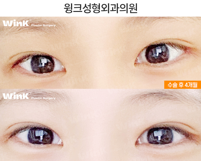 중학생 쌍커풀수술에 대해 알아볼까요? 관련 이미지 8