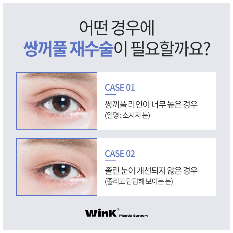 Looking for a place that does double eyelid revision surgery well? Wink Plastic Surgery eye revision surgery review image 3