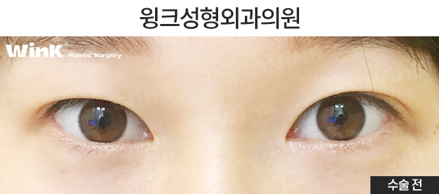 If You’re Looking Into Revision Double Eyelid Surgery, Visit Wink Plastic Surgery for Beauty and Function! image 5