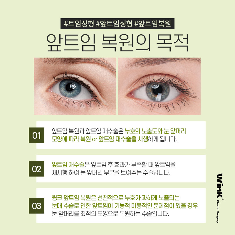 Wink Epicanthoplasty Restoration to Reclose Delicately Opened Inner Eye Corners! image 2