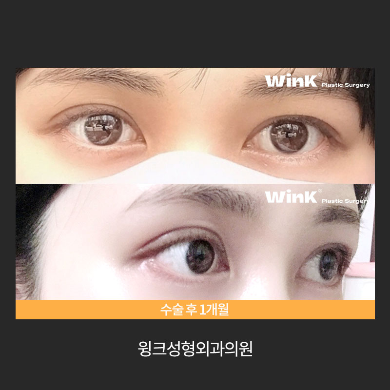 Let’s Learn About Revision Surgery for Severe Eyes? image 8