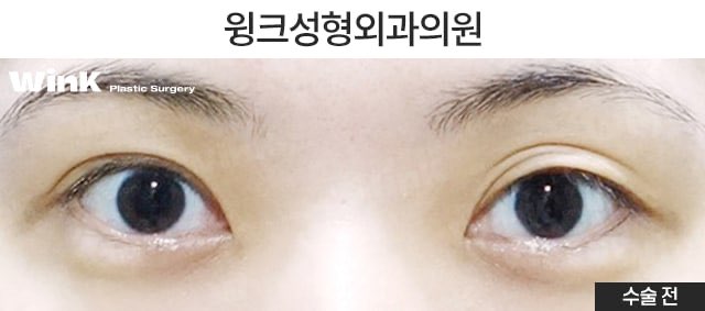 겹쌍꺼풀 해결 방법에 대해 알아보겠습니다. 관련 이미지 2