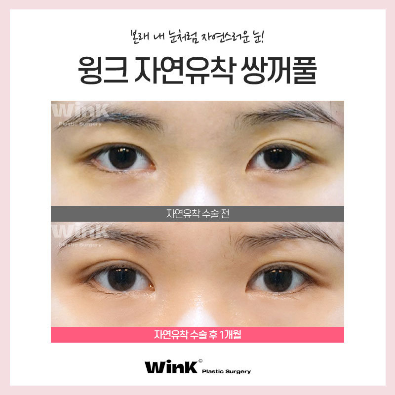자연스럽게 예뻐지고 싶다면 윙크성형외과 자연유착쌍꺼풀! 관련 이미지 5