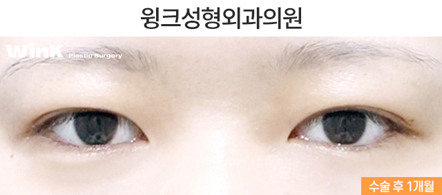 절개 쌍꺼풀 수술법에 관해 알아보겠습니다. 관련 이미지 6