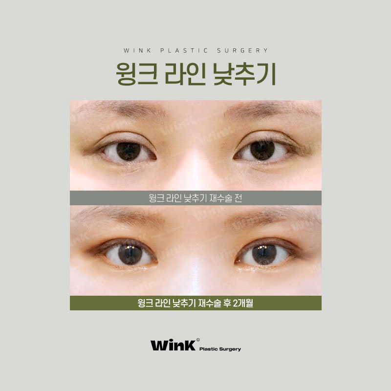 부담스러운 소세지눈? 윙크성형외과 두줄따기 쌍꺼풀 라인낮추기로 호감형 이미지로! 관련 이미지 4