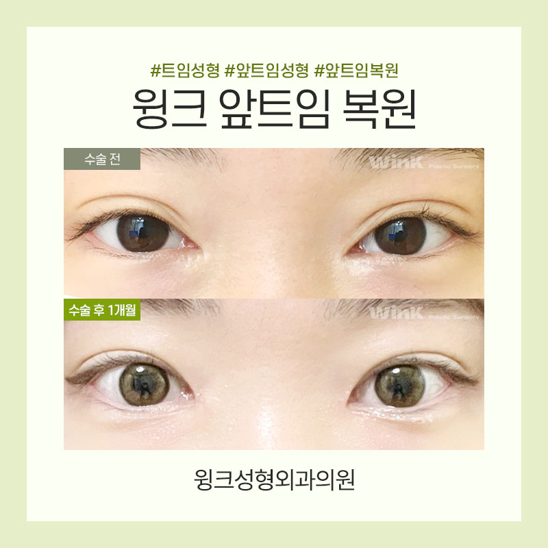 트임복원) 과도하게 트인 앞트임부작용을 앞트임복원으로 깔끔하고 자연스러운 결과 관련 이미지 7