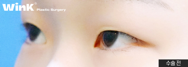 The Key to Ptosis Correction Is Proper Iris Exposure! image 2