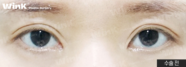 Lowering the Double Eyelid Line: Making Thick Double Eyelids (Sausage Eyes) Look Natural with a Two-Line Revision Surgery! image 6