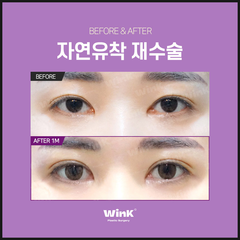 자연유착재수술 쌍수재수술 윙크성형외과 쌍꺼풀재수술 쌍꺼풀재수술후기 관련 이미지 4