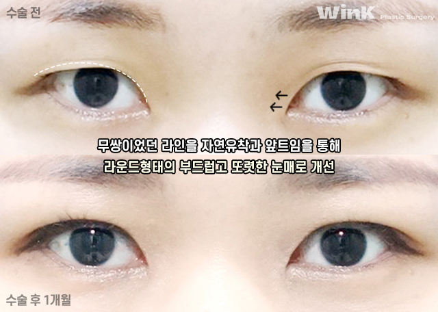 I Would Like to Talk About Natural Adhesion Double Eyelid Surgery. image 7