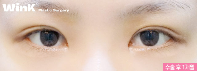 Wink Canthoplasty That Gently Lifts for a More Defined, Clear Eye Shape! image 5