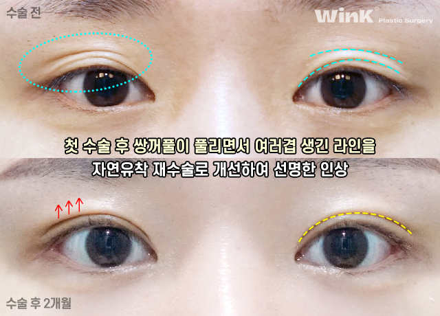 윙크 자연유착재수술로 자연스럽고 확실한 고정! 관련 이미지 8
