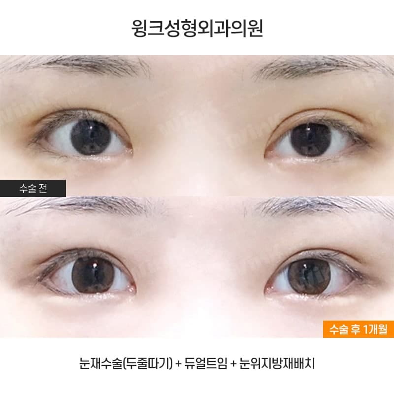 두줄따기 쌍꺼풀 라인낮추기로 부담스러운 눈매는 그만! 관련 이미지 1