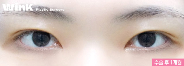 Wink Canthoplasty That Gently Lifts for a More Defined, Clear Eye Shape! image 9