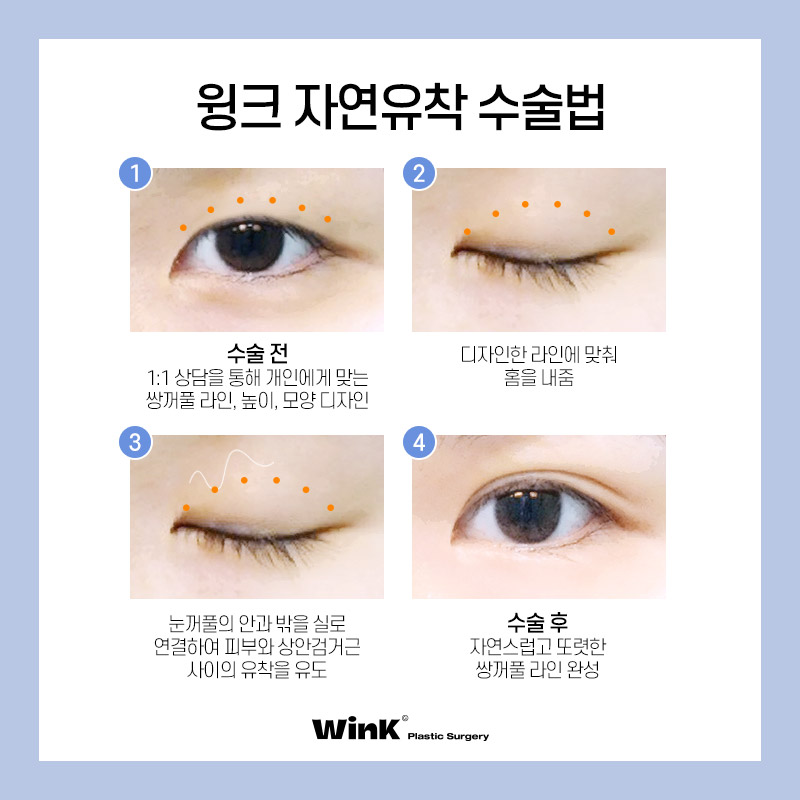 Wink Plastic Surgery’s Natural Adhesion Technique for Naturally Beautiful Eyes That Look Like They’ve Always Been There! image 3