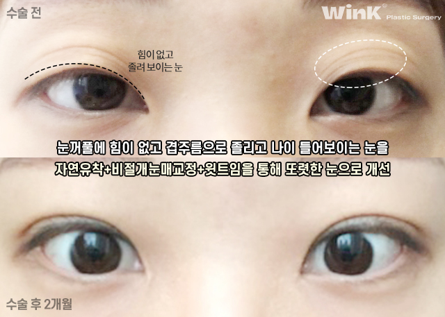 자연유착 쌍꺼풀에 대해 알아보겠습니다. 관련 이미지 7