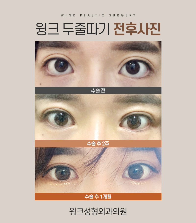두줄따기로 라인 낮추기 하고 나서 흉터는 어떨까? 관련 이미지 7