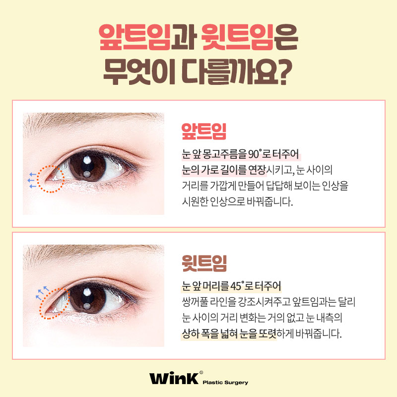 섬세하게 들어올려 또렷한 윙크윗트임 윗트임후기 윗트임잘하는곳 신사윗트임가격 관련 이미지 4