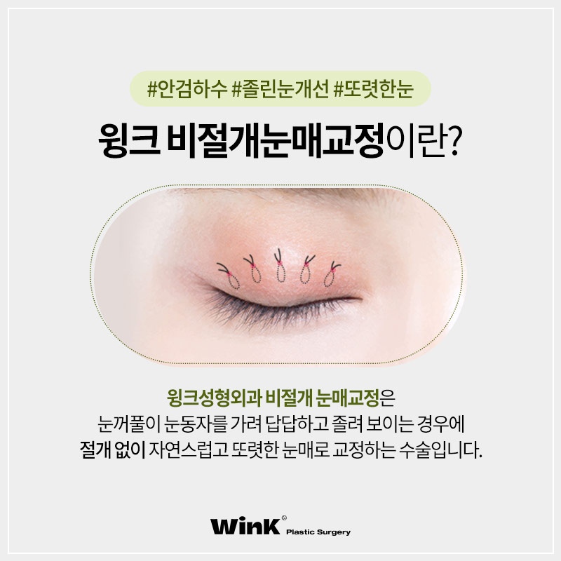 Non-incisional Eye Correction Review: A Natural, Clear Eye Shape! image 2