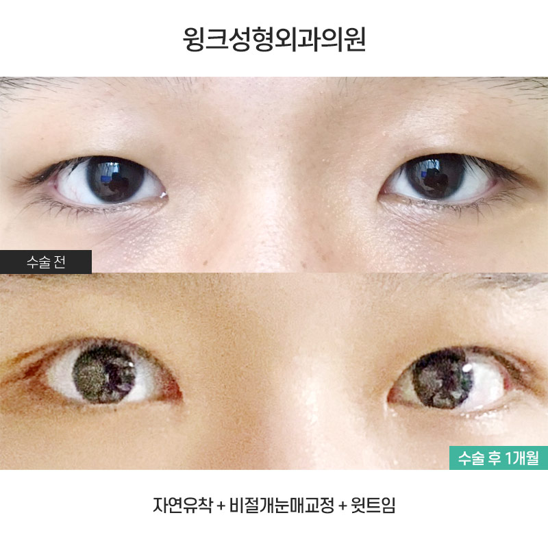 Let's Learn About Male Eye Correction and Eye Plastic Surgery image 1
