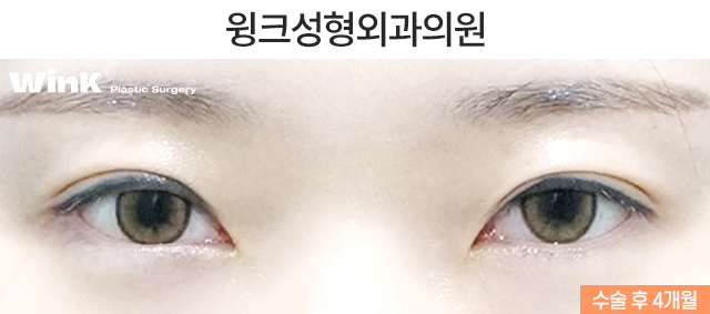 Case Examples of Correcting Uneven Eyes Through Ptosis Correction image 3