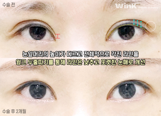 Thick Double Eyelids, “Sausage Eyes.” Let’s Improve Them Naturally with Wink’s Double-Incision Double Eyelid Revision Surgery! image 10