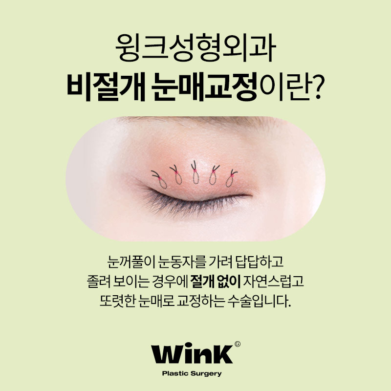 티나지 않는 또렷한 눈을 원한다면? 윙크 눈매교정 관련 이미지 4