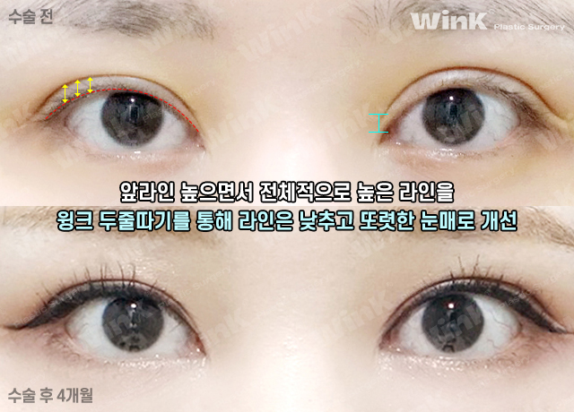 Thick Double Eyelids, “Sausage Eyes.” Let’s Improve Them Naturally with Wink’s Double-Incision Double Eyelid Revision Surgery! image 6