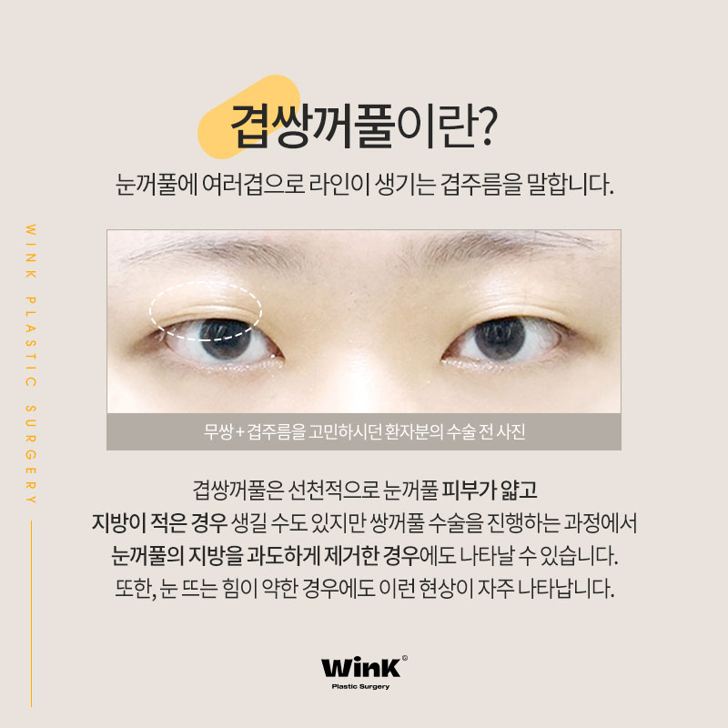 윙크성형외과에서 알려드리는 겹쌍꺼풀과 눈 뜨는 힘이 중요한 이유! 관련 이미지 2