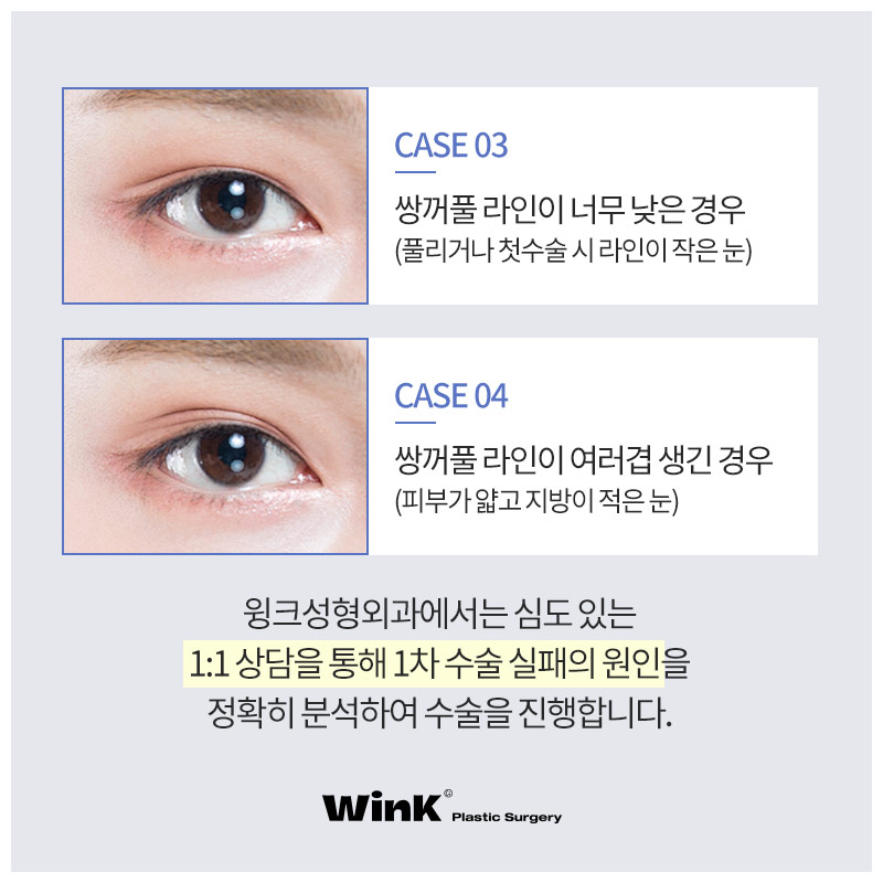 Looking for a place that does double eyelid revision surgery well? Wink Plastic Surgery eye revision surgery review image 4