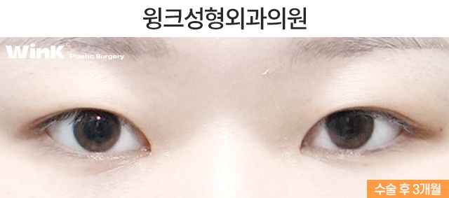 절개 쌍꺼풀 수술법에 관해 알아보겠습니다. 관련 이미지 3