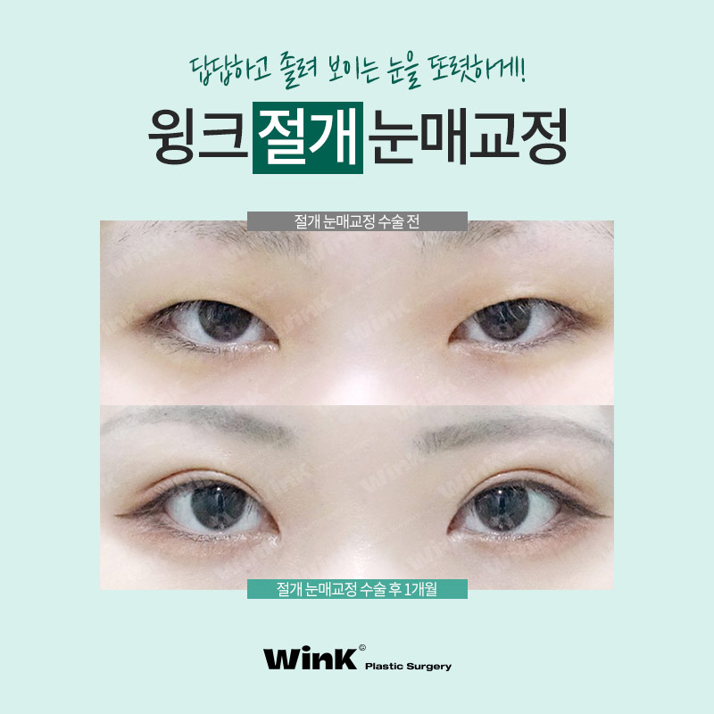 윙크성형외과 비절개 or 절개 눈매교정! 나에게 맞는 눈매교정은? 관련 이미지 7